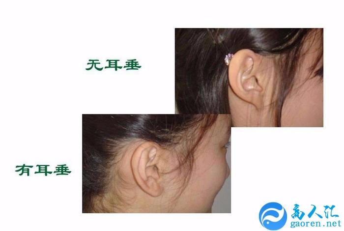 没有耳垂,也就是少了耳珠部分的耳朵又称半桃耳,没有耳垂的人大多是嘴