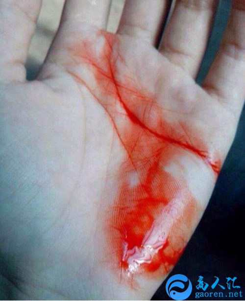 手受伤流血真实图片